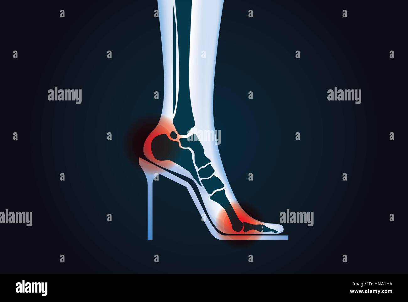 Red signal at foot bone area because wearing high heels. This illustration about health care. Stock Vector