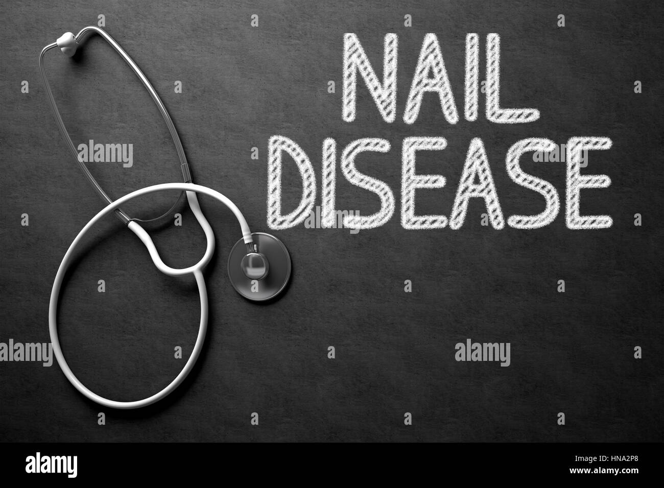 Chalkboard with Nail Disease Concept. 3D Illustration. Stock Photo
