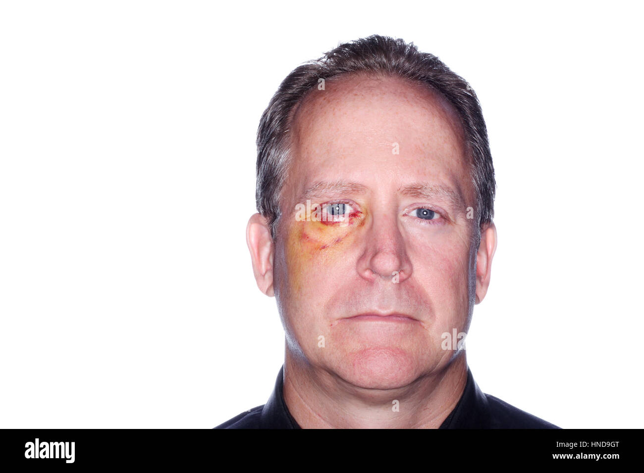 man with black eye Stock Photo