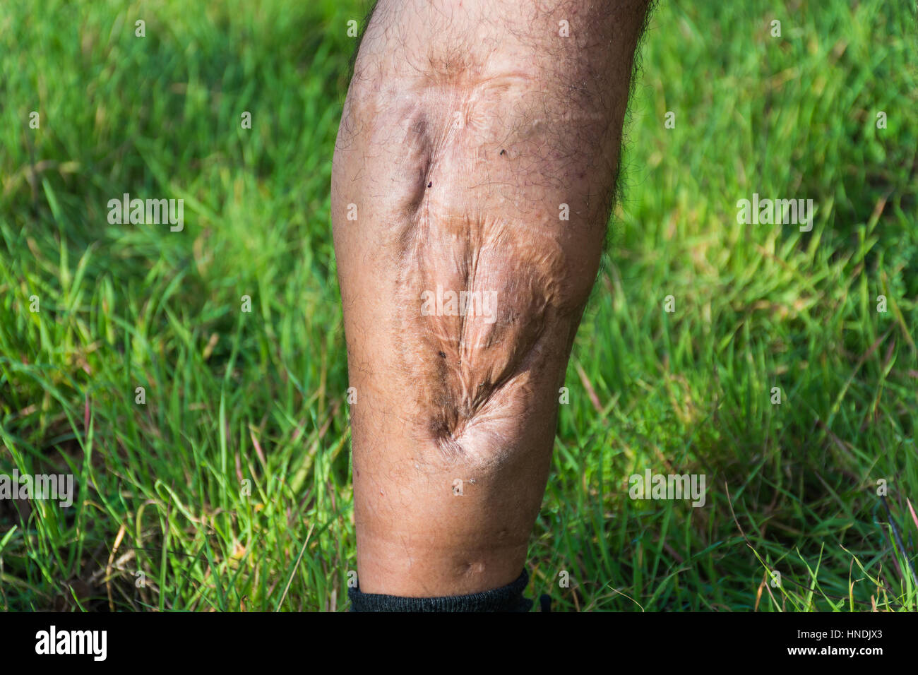 Old scar of leg injury, from car or motorbike accident, deep tissue