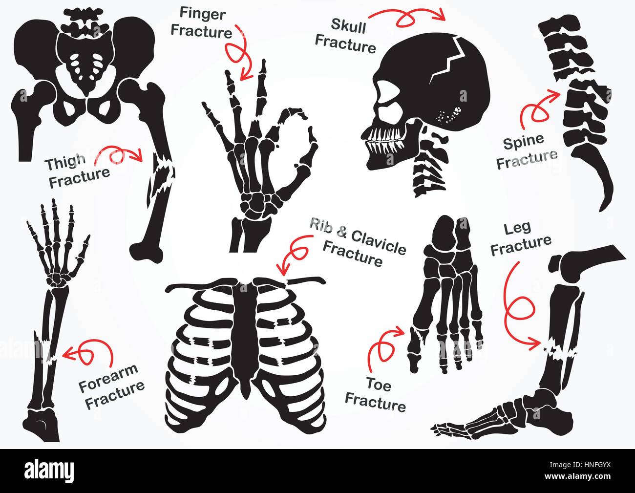 Set Bone Fracture Icon ( Pelvic , Hip , Thigh ( femur ) , Hand , Wrist , Finger , Skull , Face , Vertebra , Arm , Elbow , Thorax , Foot , Heel , Leg ) Stock Vector
