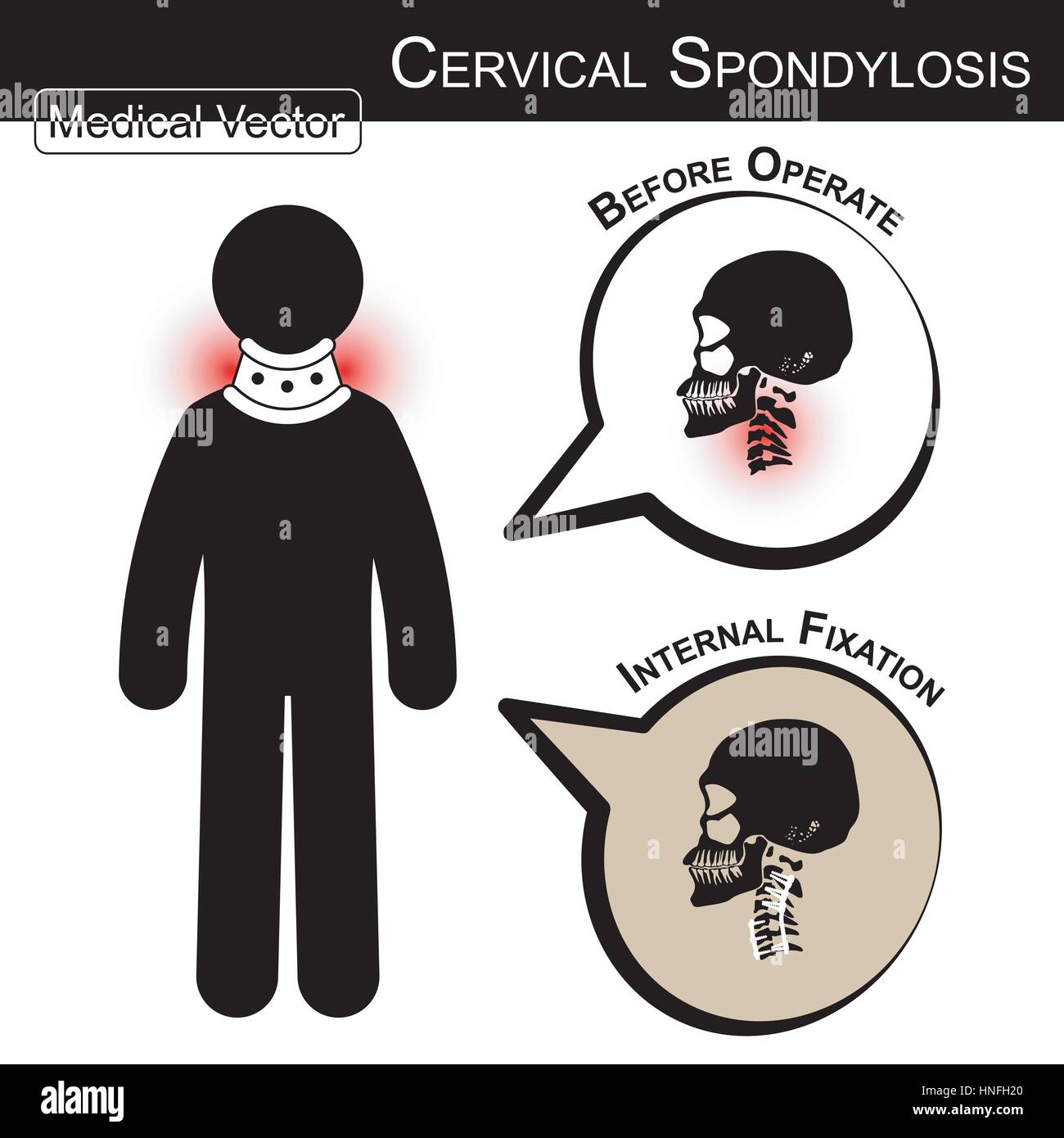 Stick man with hard collar ( Cervical spondylosis ) and bubble ( Before operate , After operate internal fixation by plate and screw at cervical spine Stock Vector