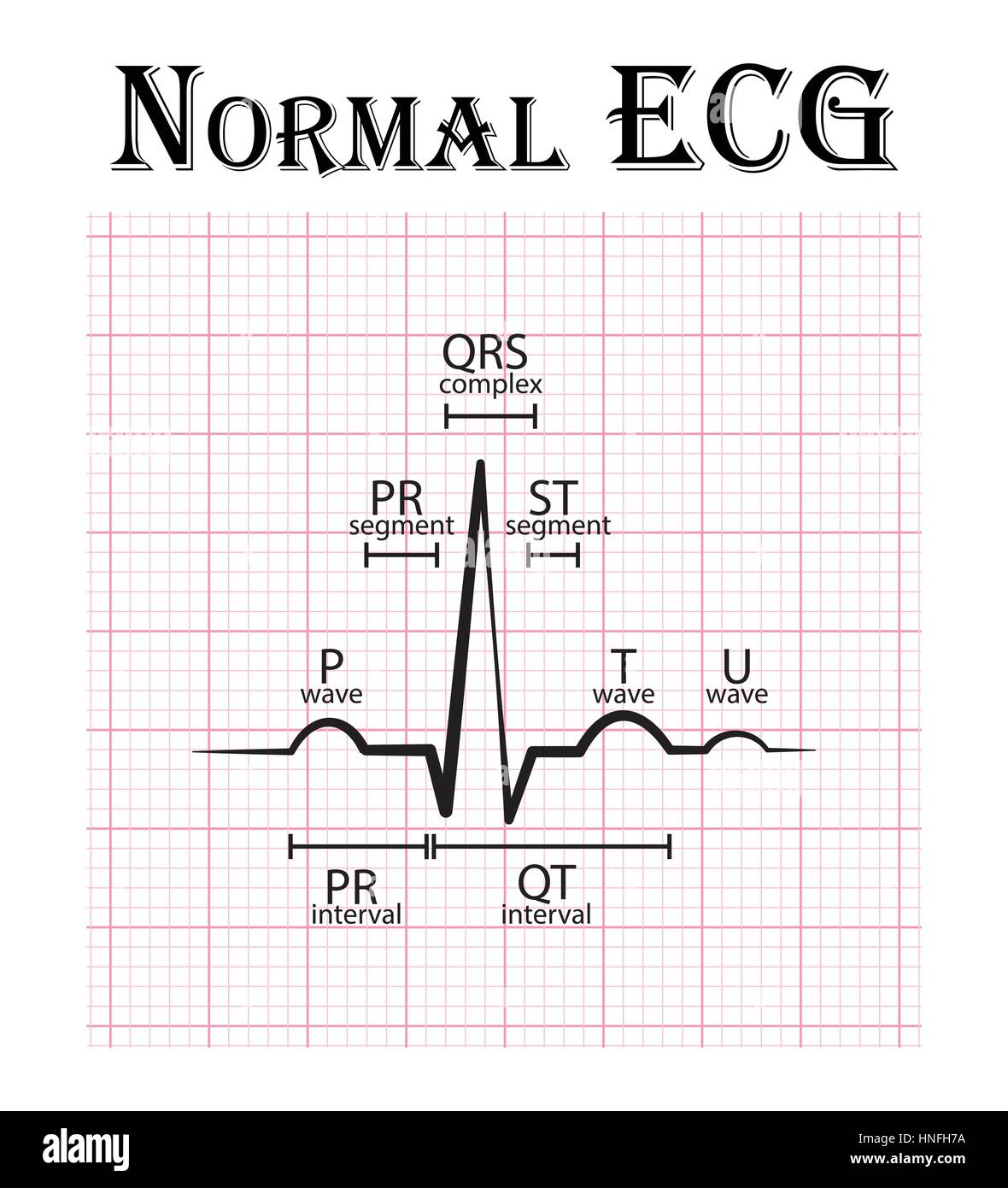 Normal Ecg High Resolution Stock Photography and Images - Alamy