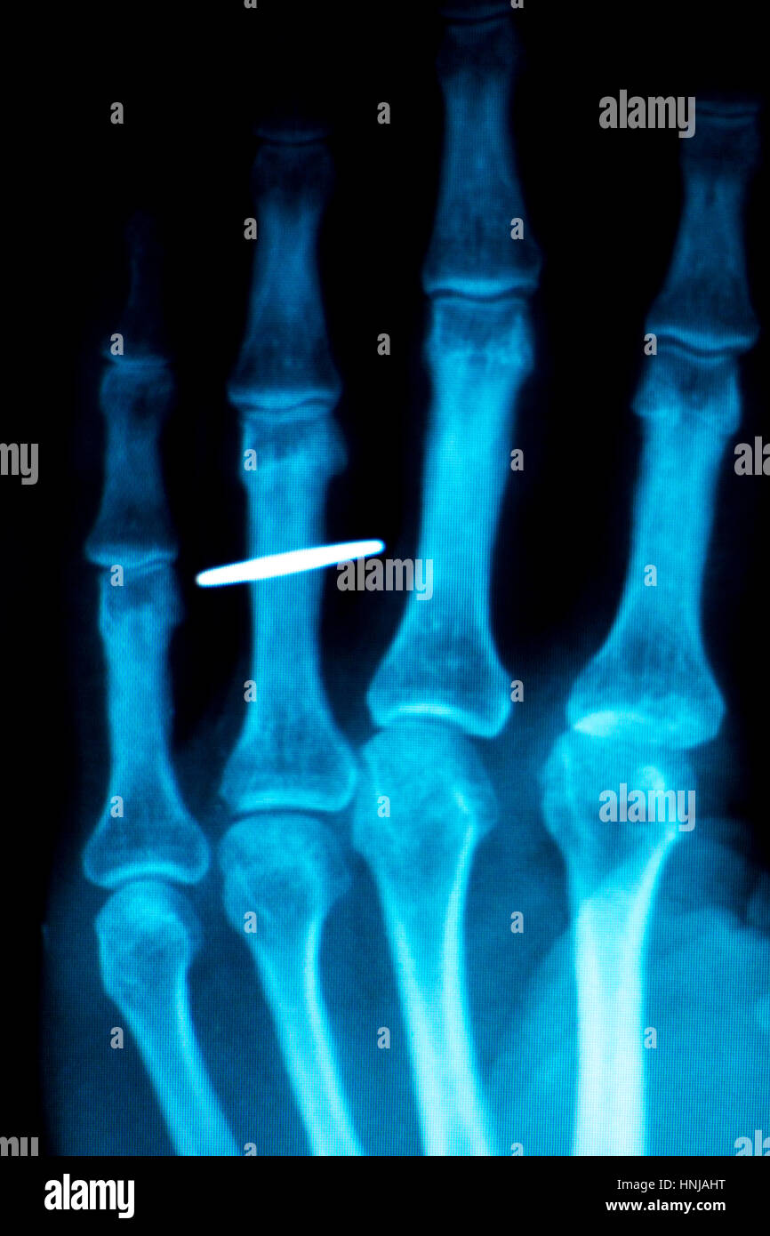 Orthopedics Hand finger joint meniscus, ligament, tendon and cartilage injury titanium modern metal implant X-ray scan. Stock Photo