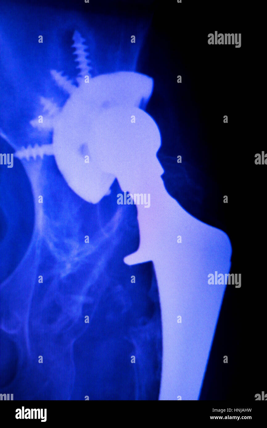 Orthopedics knee joint titanium modern metal implant replacement with