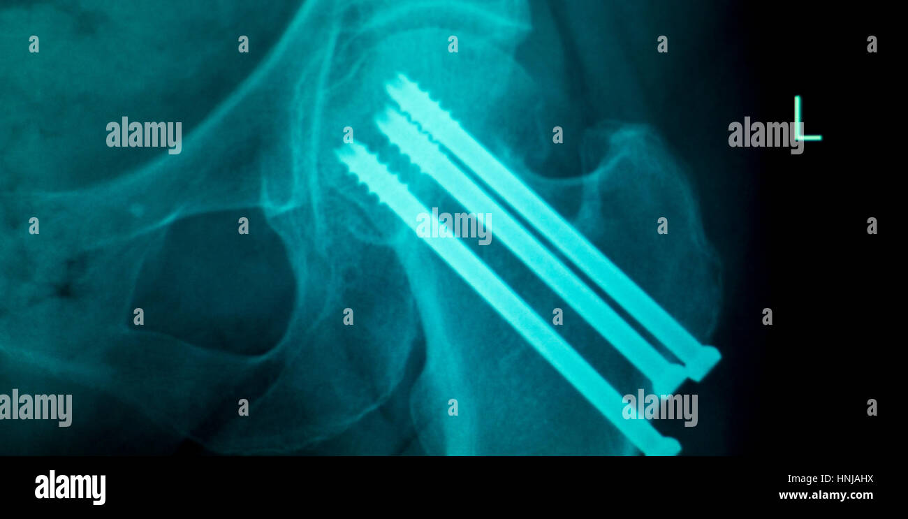 Orthopedics knee joint titanium modern metal implant screws Xray scan