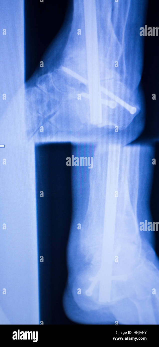 Xray foot heel ankle test scan results showing orthopedic titanium
