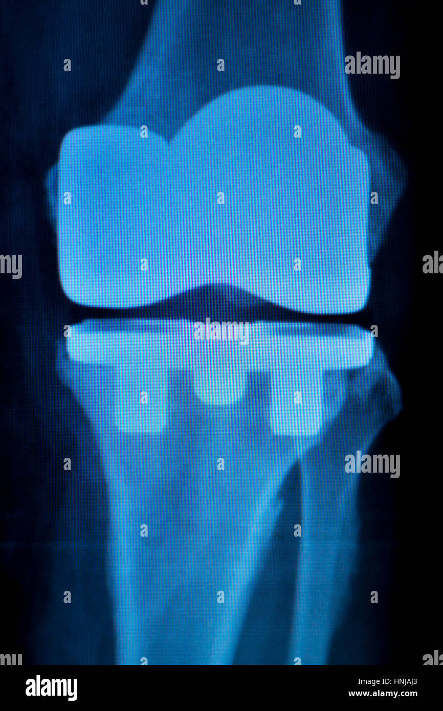 Orthopedics knee joint meniscus, ligament, tendon and cartilage injury