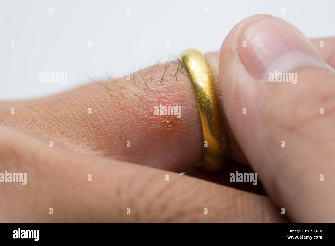 Closeup for allergic rash on finger (gold ring) Stock Photo
