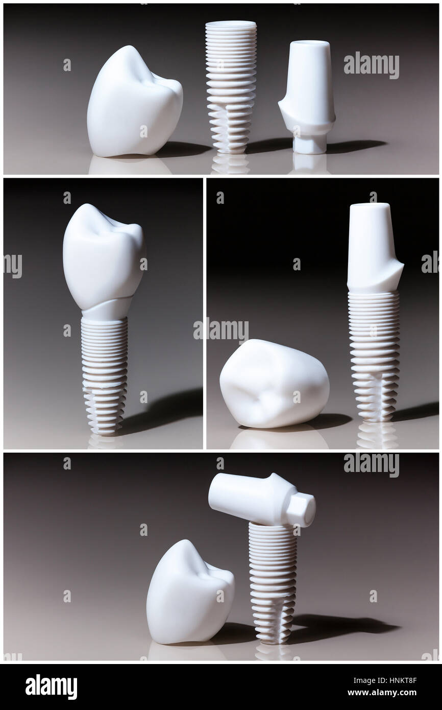 Models of dental, implants, dental dentist objects implants composition