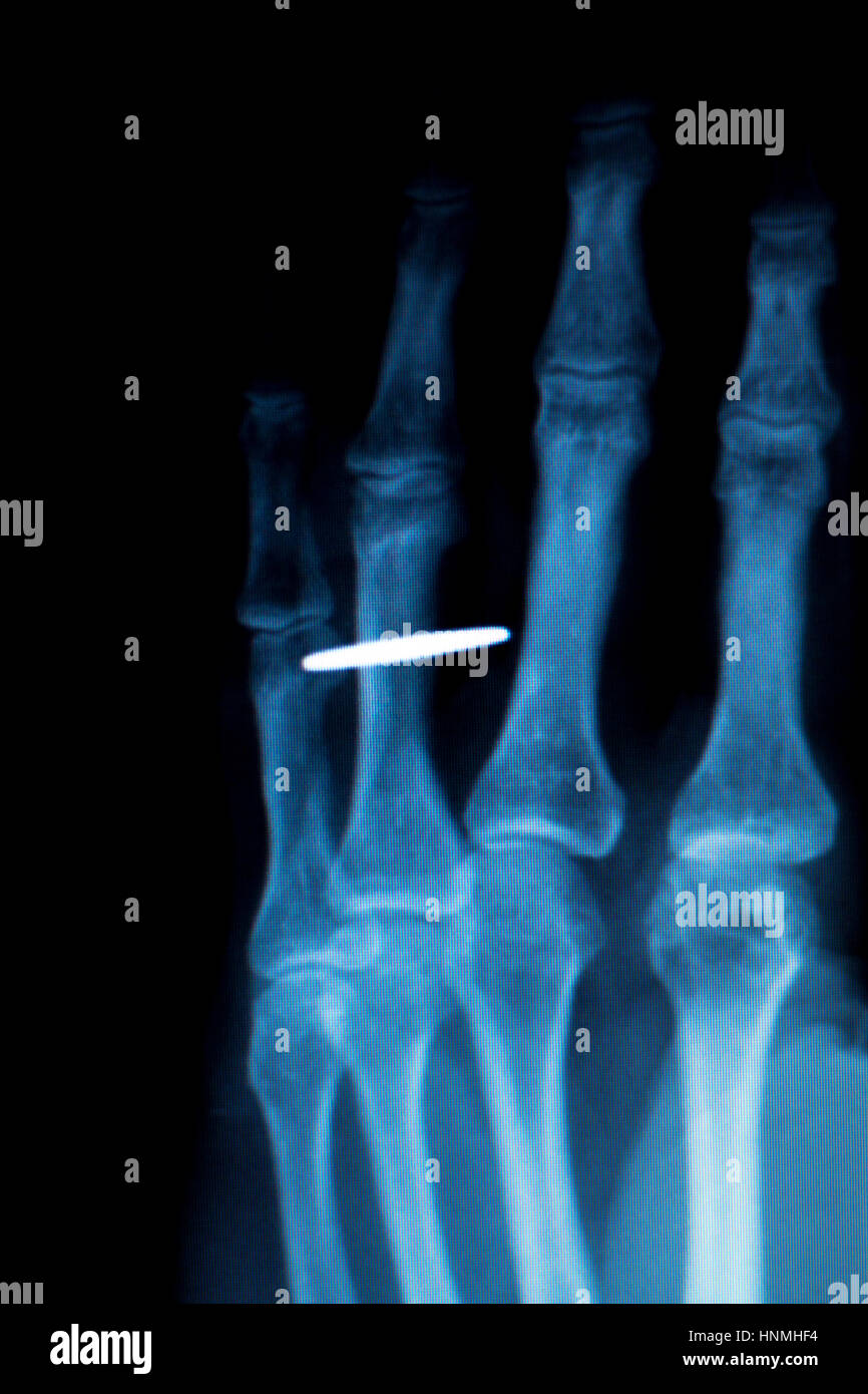 Orthopedics Hand finger joint meniscus, ligament, tendon and cartilage injury titanium modern metal implant X-ray scan. Stock Photo
