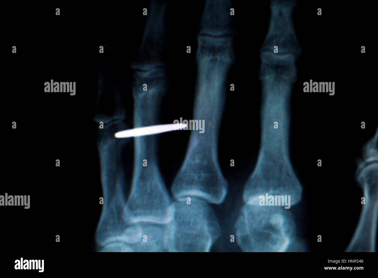 Orthopedics Hand finger joint meniscus, ligament, tendon and cartilage injury titanium modern metal implant X-ray scan. Stock Photo