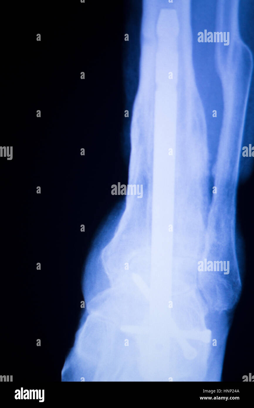 Xray foot heel ankle test scan results showing orthopedic titanium