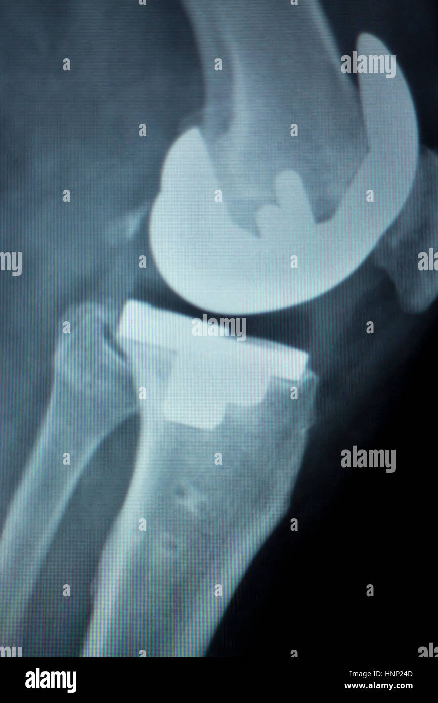 Orthopedics knee joint meniscus, ligament, tendon and cartilage injury
