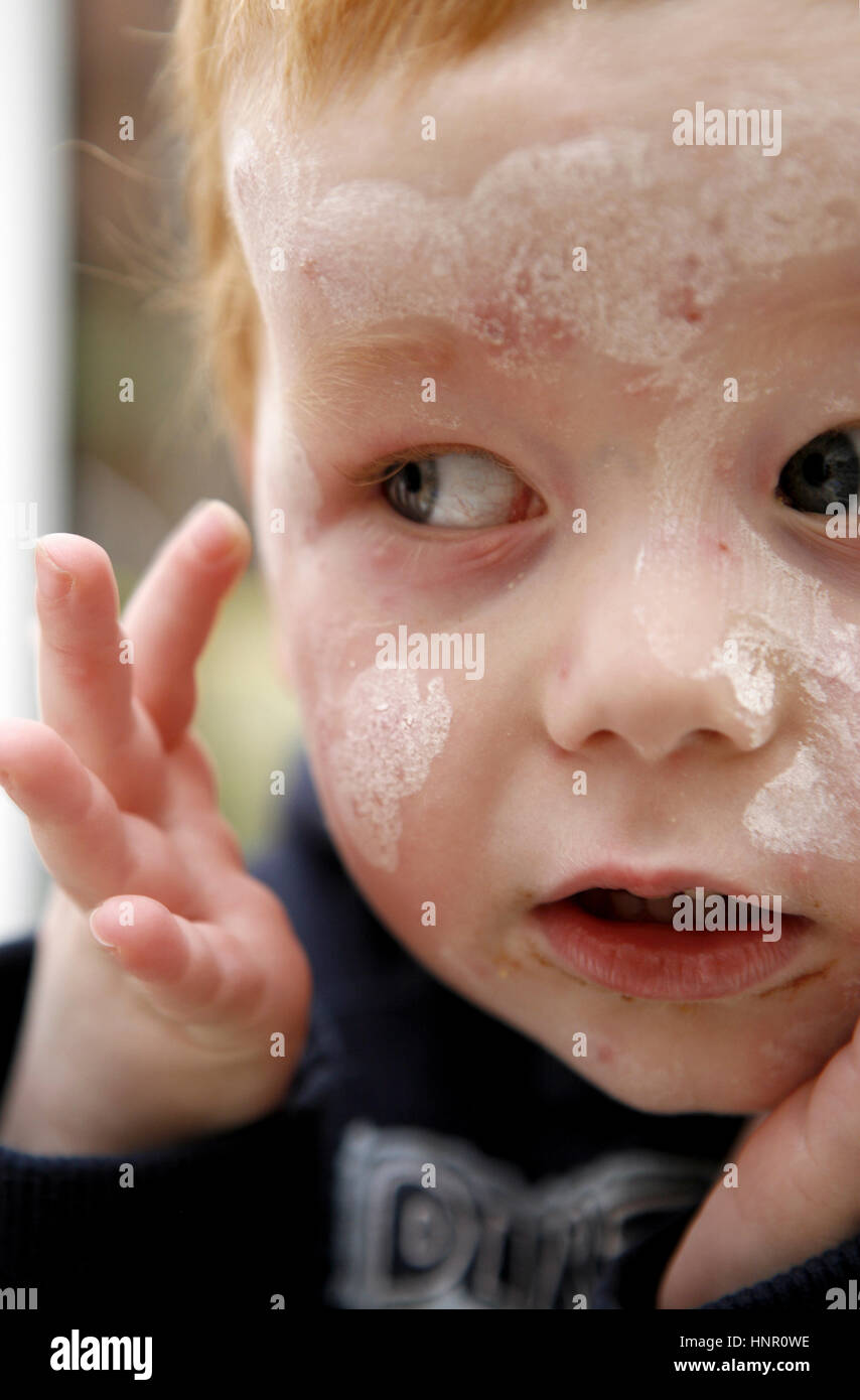 Child with chicken pox spots on face and calamine lotion Stock Photo