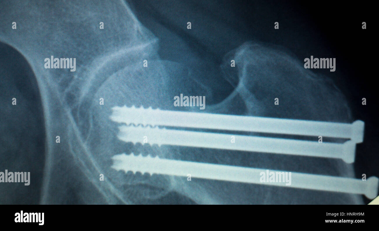 Orthopedics knee joint titanium modern metal implant screws Xray scan