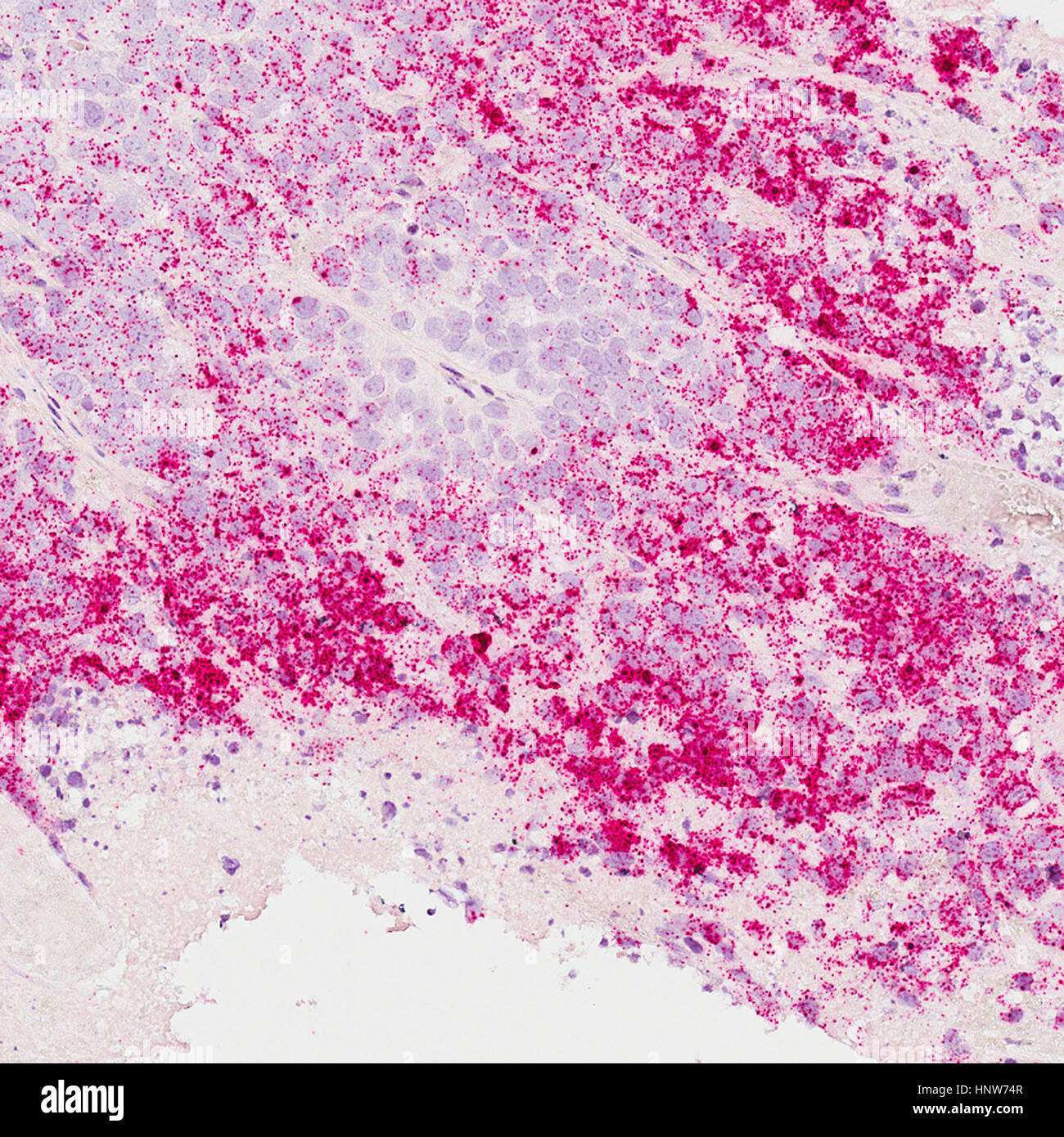 Full frame microscopic image of breast cancer cells Stock Photo - Alamy