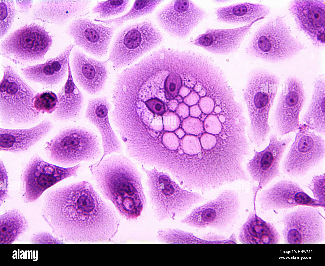 Koilocytes, squamous epithelial cells, altered by human papillomavirus Stock Photo