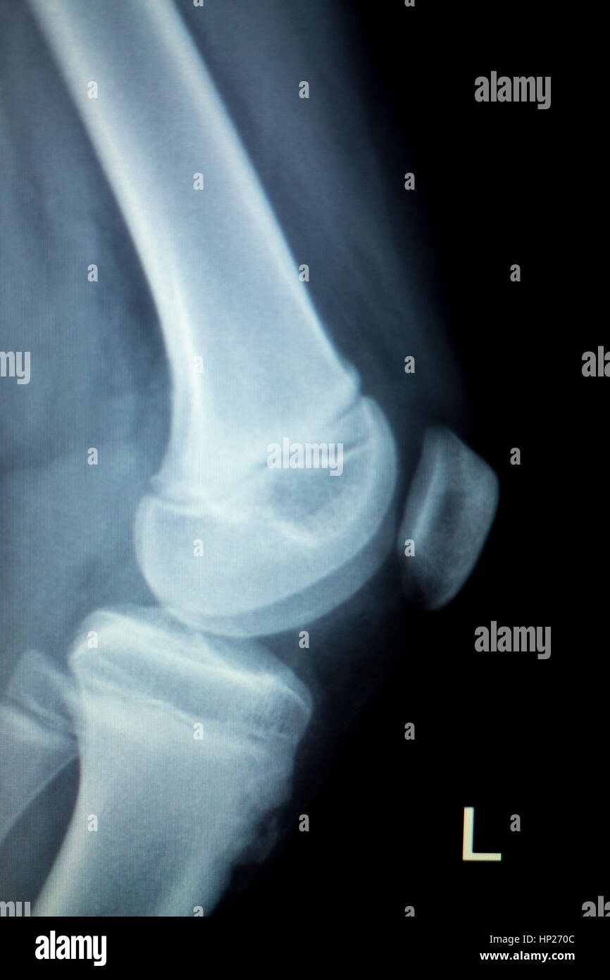 Orthopedics knee joint meniscus, ligament, tendon and cartilage injury