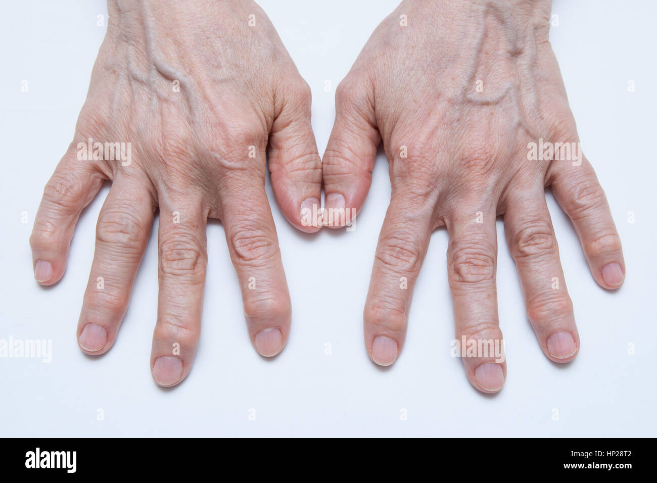 Ревматоид артрит васкулит. Поражение суставов при ревматоидном артрите. Ревматоидный артрит сестринский процесс. Артрит соединительных тканей. Суставная форма ревматоидного артрита.