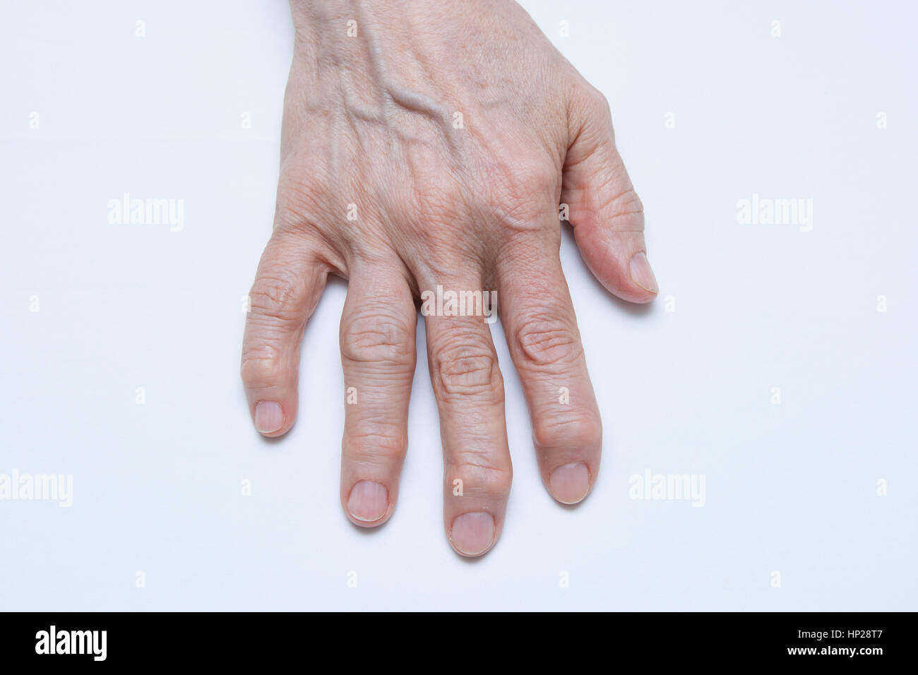 Osteoarthritis Hands and fingers of a female Stock Photo Alamy