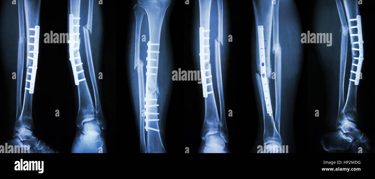 Collection Image Of Leg Fracture And Surgical Treatment By Internal