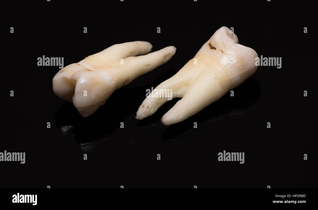 Human Wisdom Teeth High Resolution Stock Photography and Images - Alamy