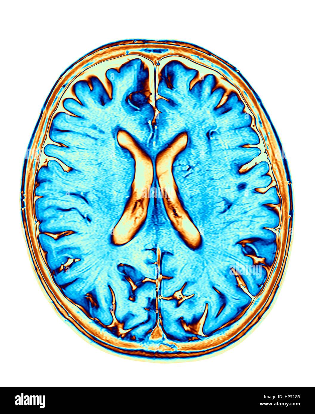 Normal brain. Coloured magnetic resonance imaging (MRI) scan of an axial section through a healthy brain, The images shows the cortex and lateral ventricle (X-shaped in the middle). Stock Photo