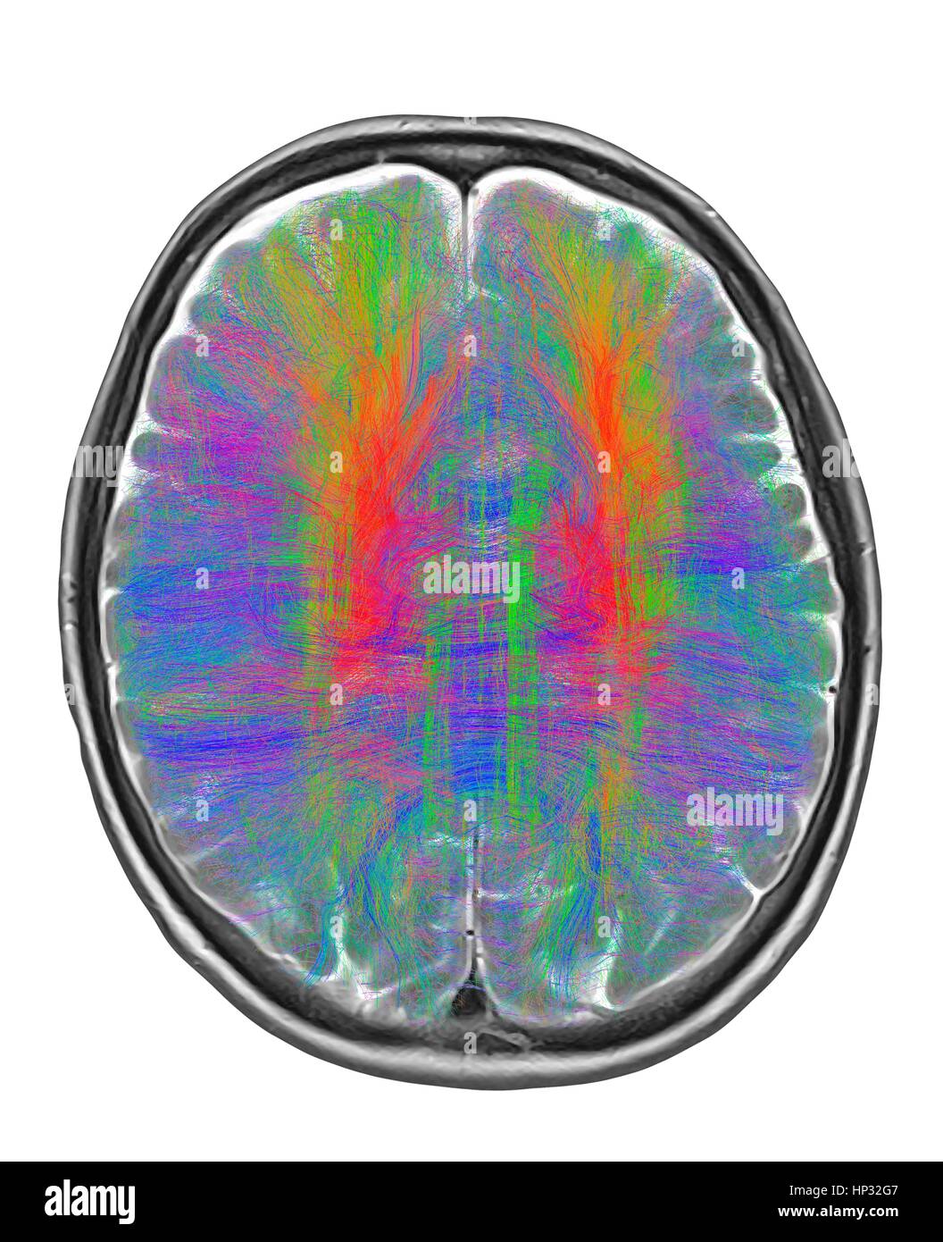 Computer artwork of MRI top view of brain showing white matter fibres.Coloured 3D diffusion spectral imaging (DSI) scan of bundles of white matter nerve fibres in brain.The fibres transmit nerve signals between brain regions between brain spinal cord.Diffusion spectrum imaging (DSI) is variant of Stock Photo