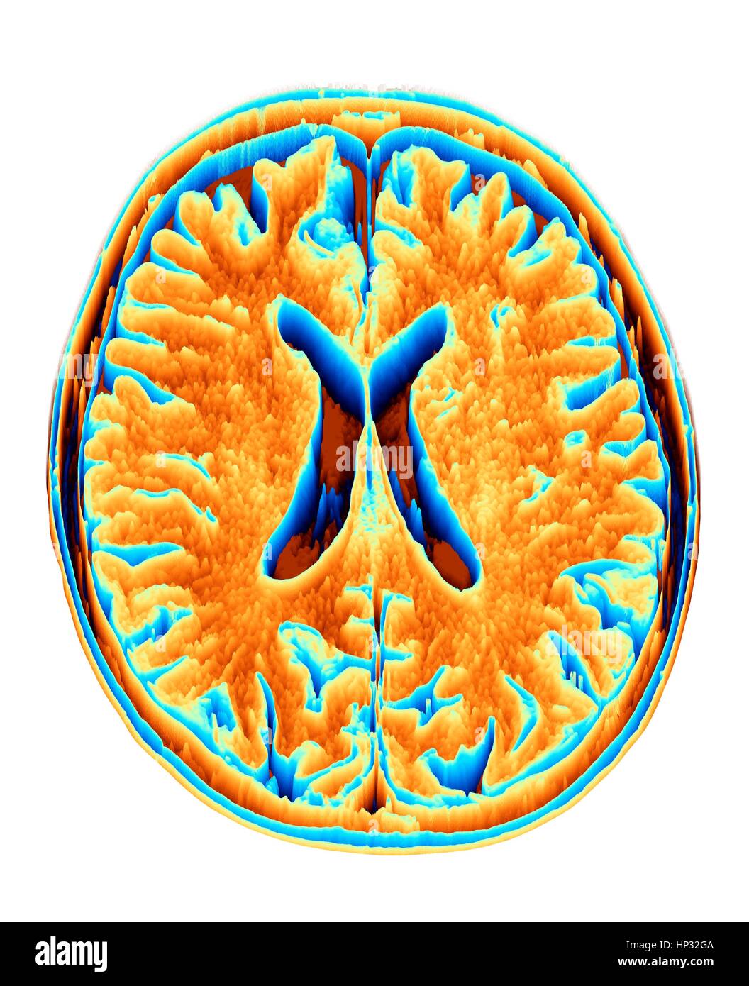 Normal brain. Coloured magnetic resonance imaging (MRI) scan of an axial section through a healthy brain, converted into a heightmap or height field. The images shows the cortex and lateral ventricle (X-shaped in the middle). Stock Photo