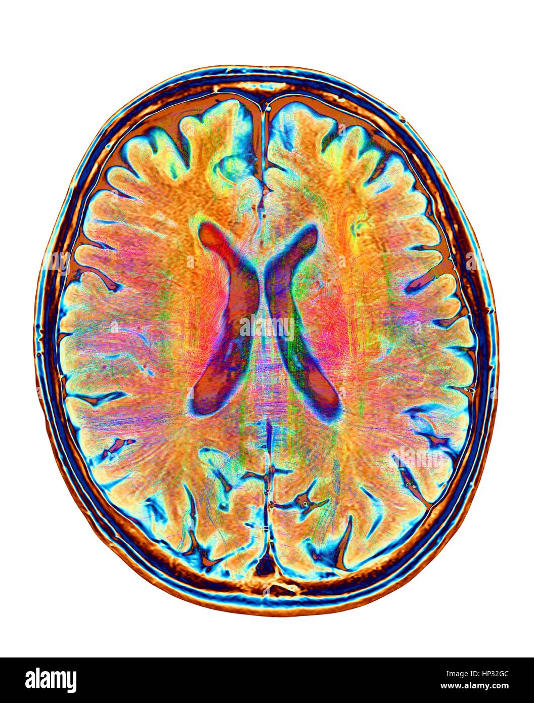 Computer artwork of MRI top view of brain showing white matter fibres.Coloured 3D diffusion spectral imaging (DSI) scan of bundles of white matter nerve fibres in brain.The fibres transmit nerve signals between brain regions between brain spinal cord.Diffusion spectrum imaging (DSI) is variant of Stock Photo