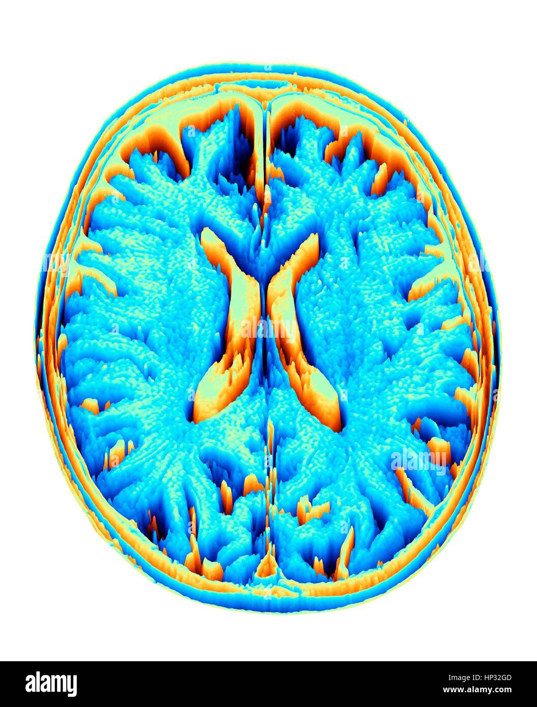 Normal brain. Coloured magnetic resonance imaging (MRI) scan of an axial section through a healthy brain, converted into a heightmap or height field. The images shows the cortex and lateral ventricle (X-shaped in the middle). Stock Photo