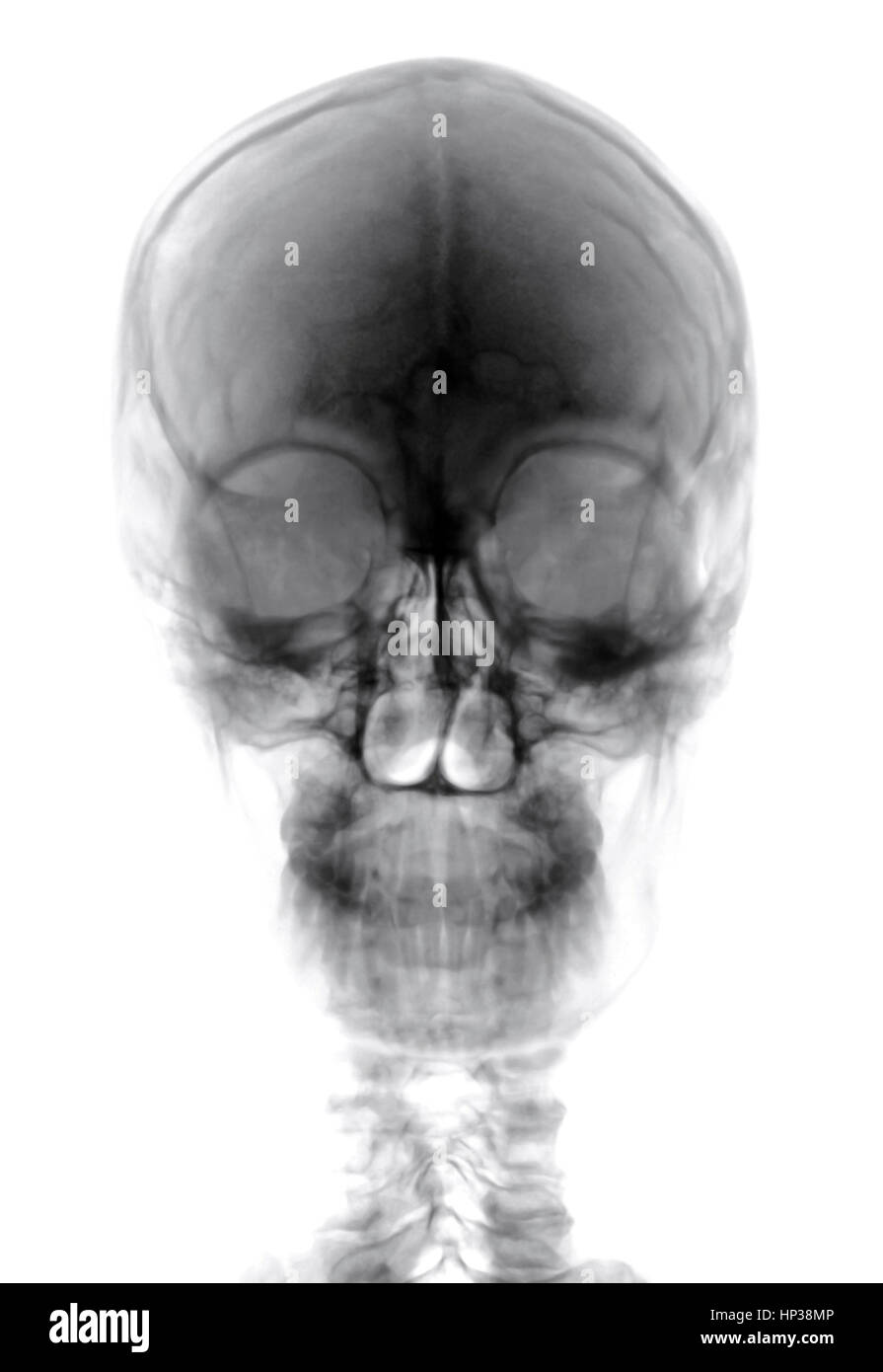 Human Head on Black and white x-ray film Stock Photo
