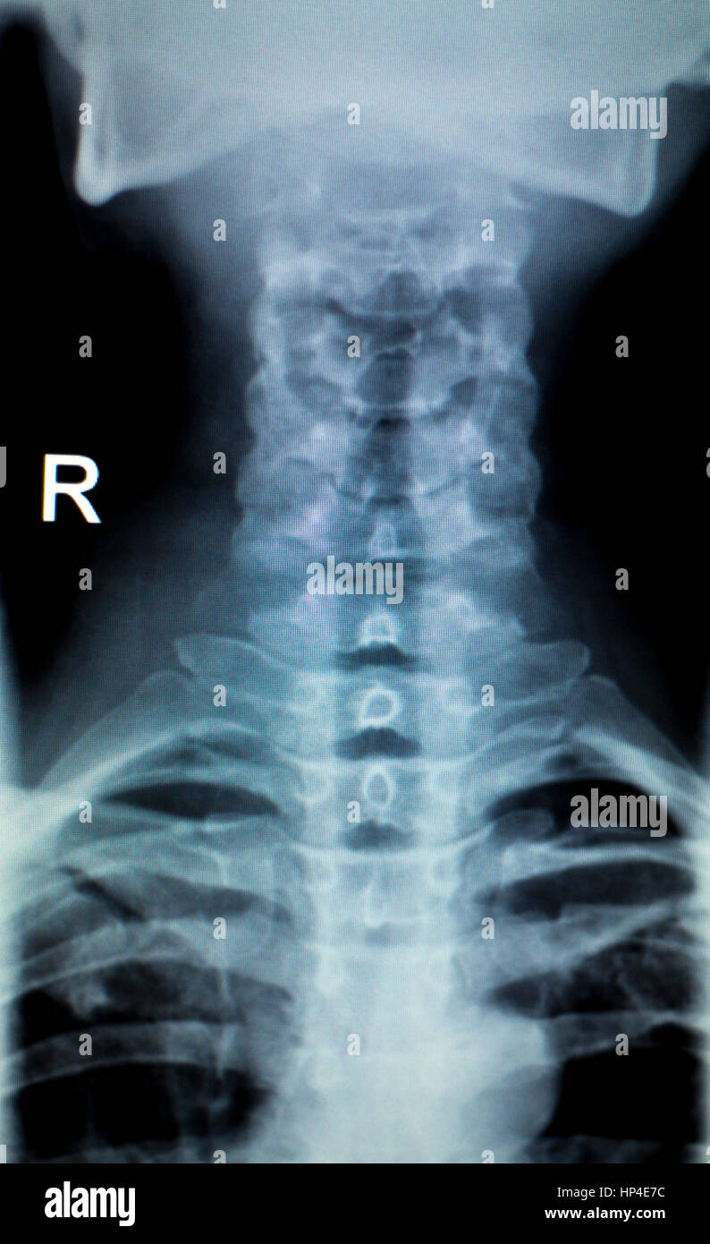 Orthopedics upper spine and neck Xray scan test results for old age