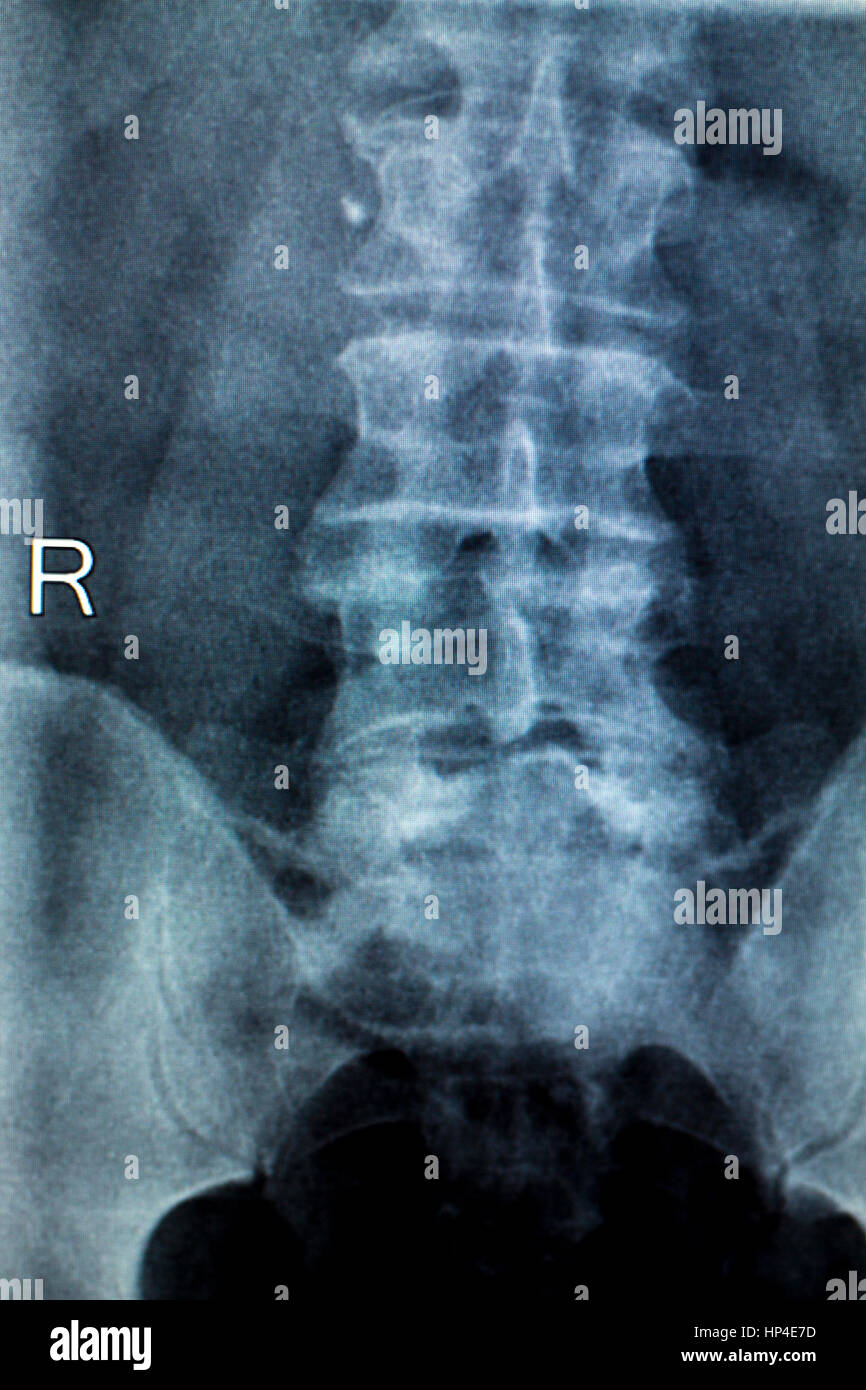 X Ray Lower Back Stock Photos & X Ray Lower Back Stock Images Alamy