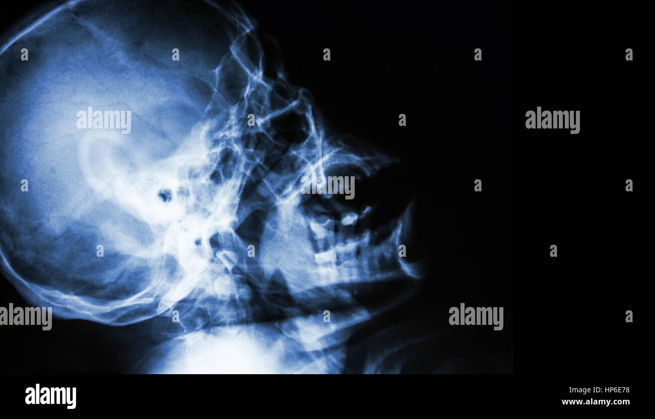 Film X-ray of normal human skull . lateral view . blank area at right side . Stock Photo