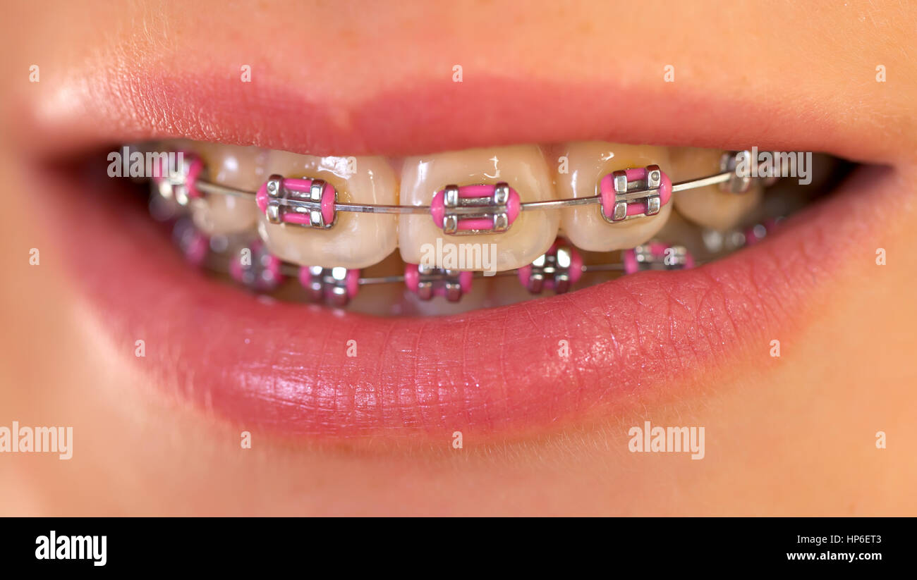 Pink braces online