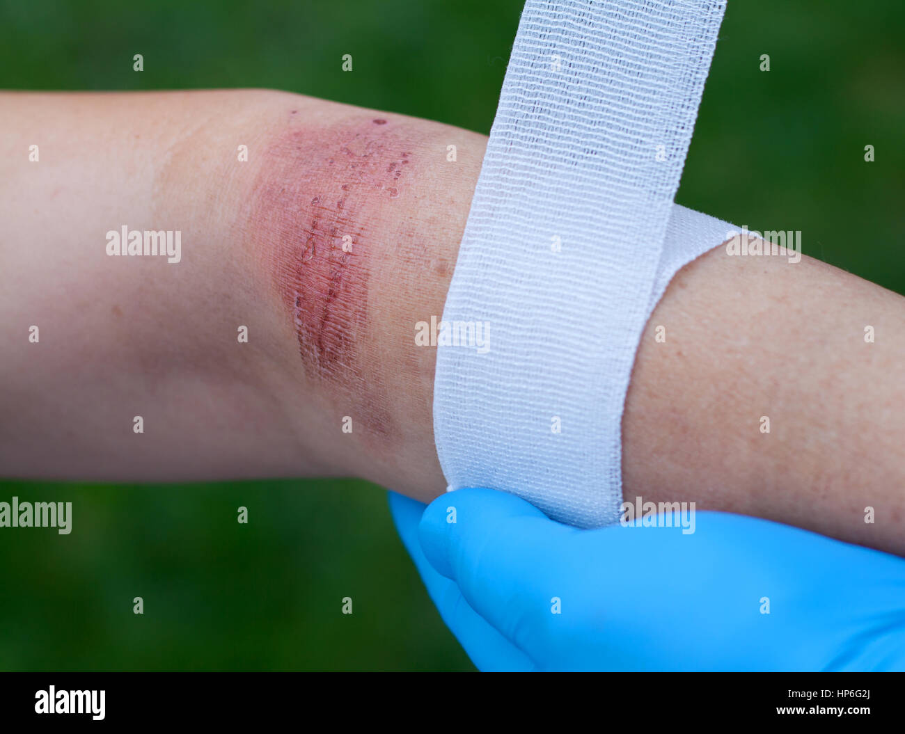 Doctor's hand healing a burned skin area Stock Photo