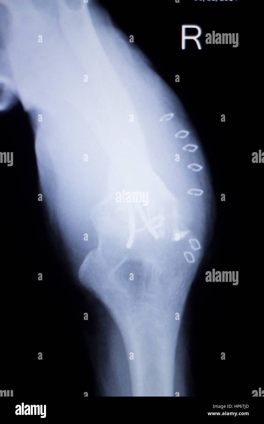 Elbow joint titanium metal modern implant xray test scan result after