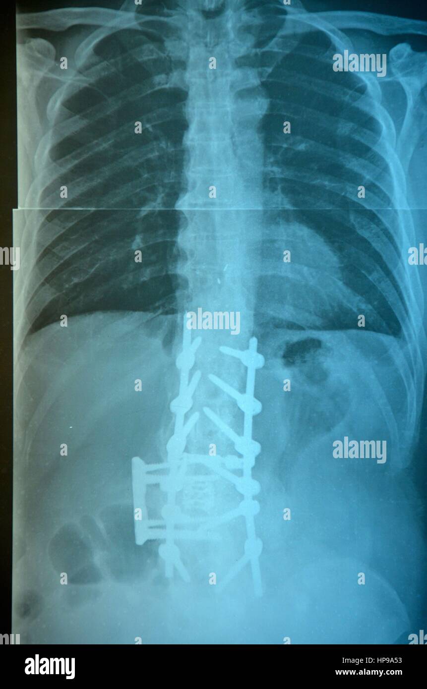 Spine X-Ray Stock Photo