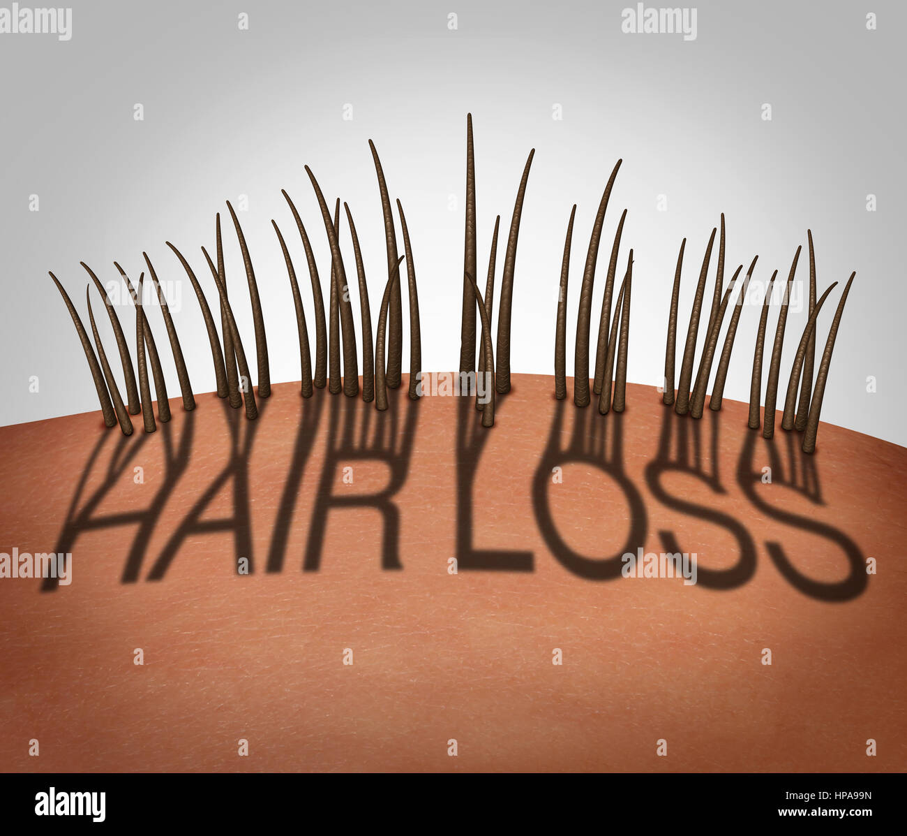 Hair loss and balding medical concept as a receding hairline with text as a shadow with thinning follicles on a mostly bald head. Stock Photo