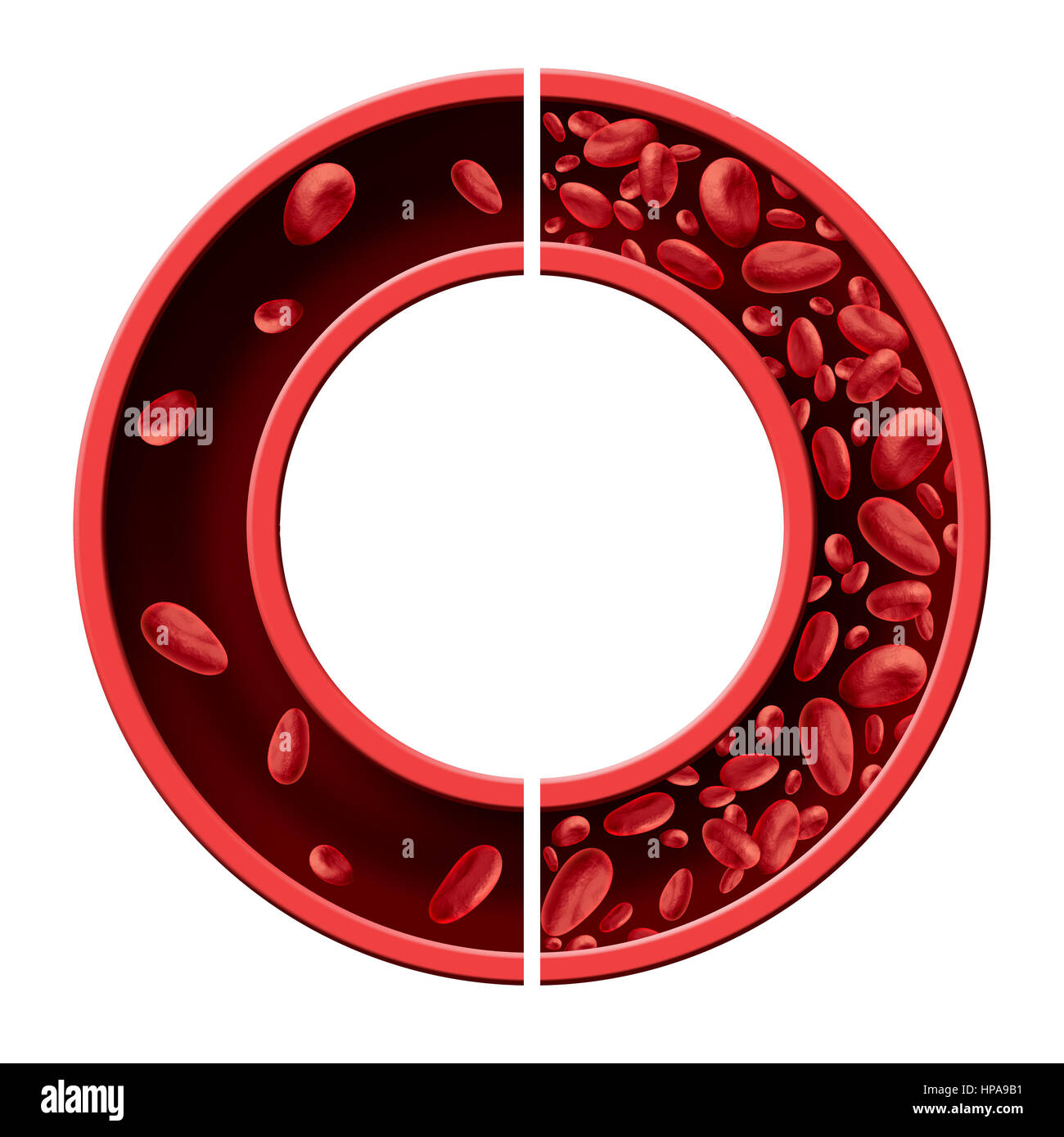 Anemia and anaemia medical diagram concept as normal and abnormal blood cell count and human circulation in an artery or vein. Stock Photo