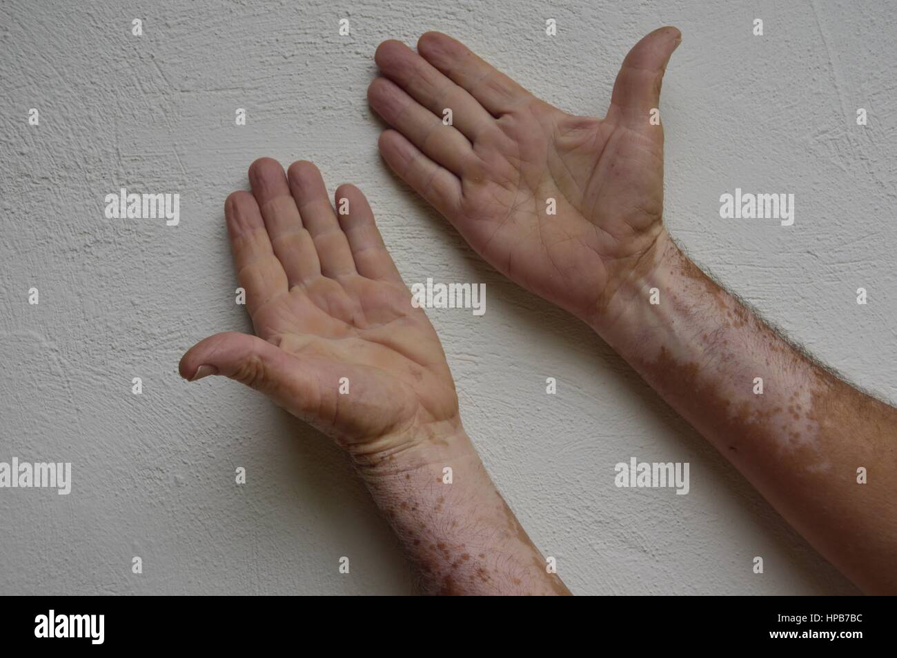 Vitiligo datiert india