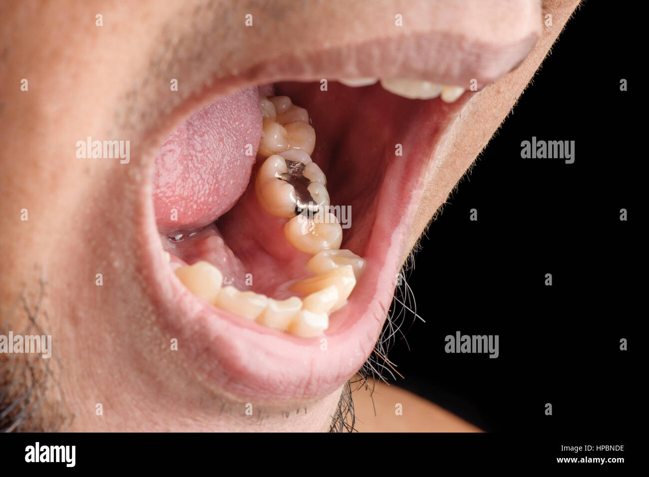 Dental Filling | Tooth Filling | Cavity Filling | Silver Filling Stock Photo