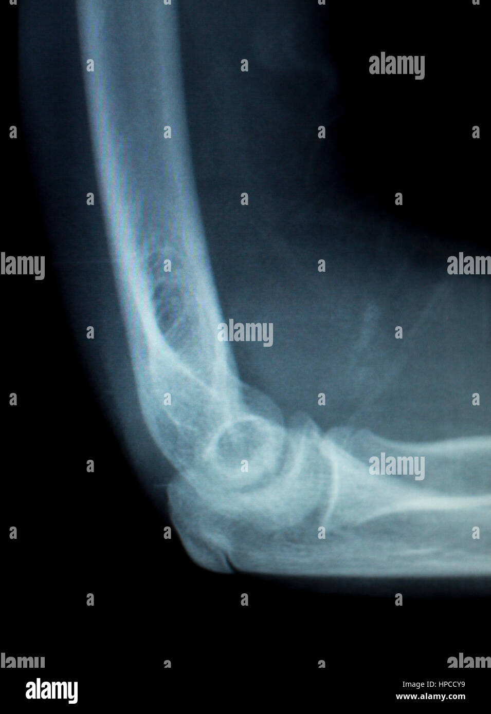 Elbow joint tennis elbow inury xray test scan result before