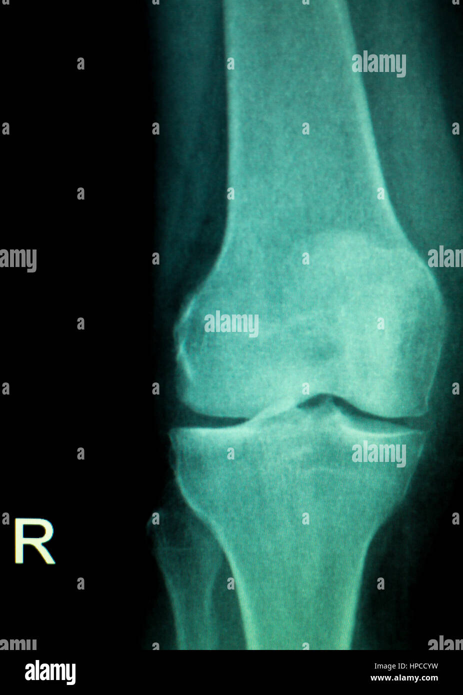 Orthopedics knee joint meniscus, ligament, tendon and cartilage injury