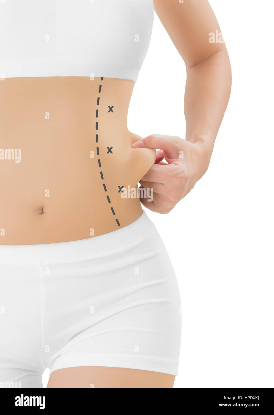 Woman grabbing skin on her flanks with the black color crosses marking,  Lose weight and liposuction cellulite removal concept, Isolated on white  backg Stock Photo - Alamy