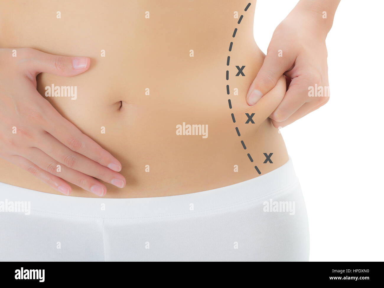 Woman grabbing skin on her flanks with black color crosses marking, Lose  weight and liposuction cellulite removal concept, Isolated on white  backgroun Stock Photo - Alamy