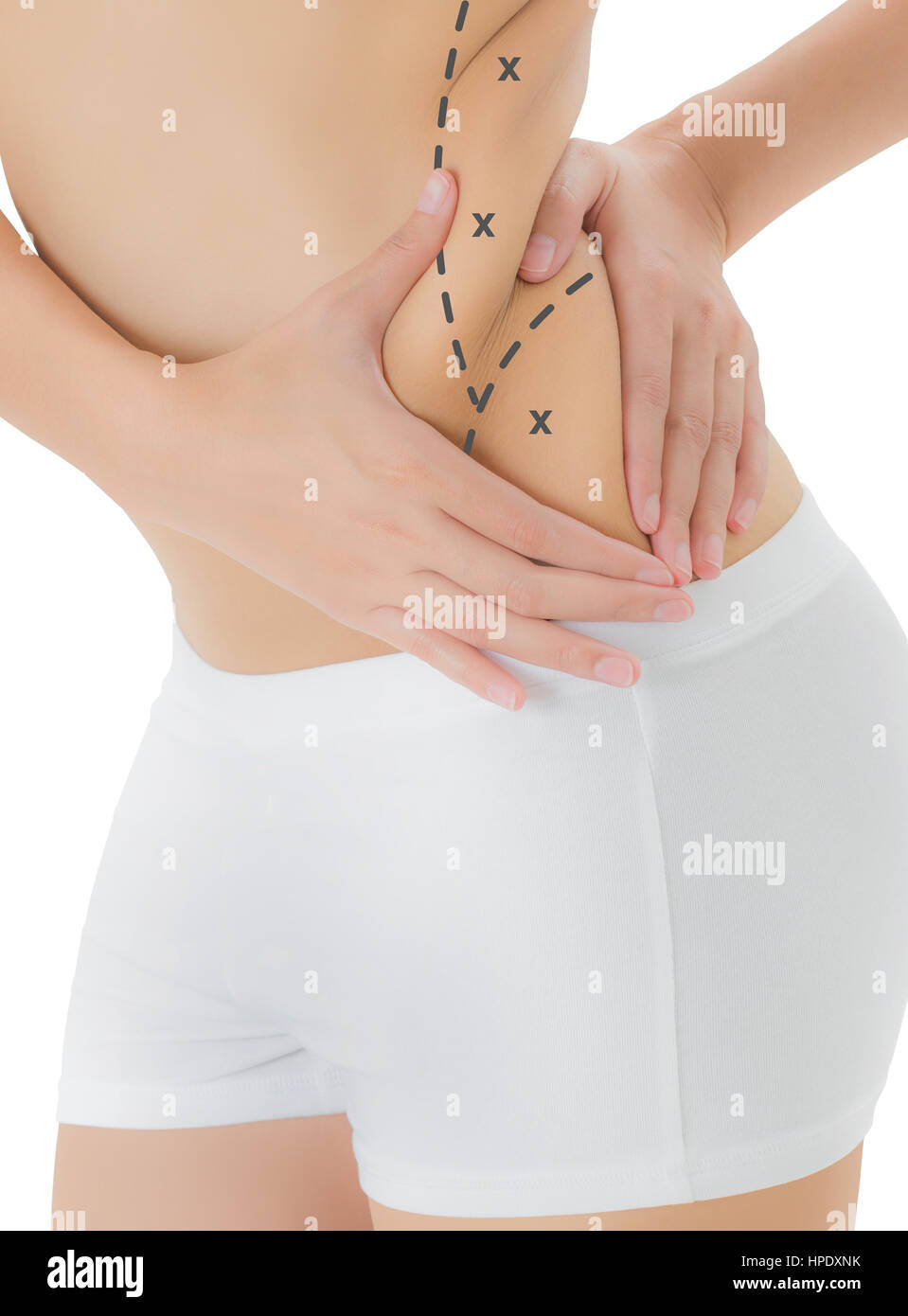 Woman grabbing skin on her flanks with the black color crosses marking,  Lose weight and liposuction cellulite removal concept, Isolated on white  backg Stock Photo - Alamy