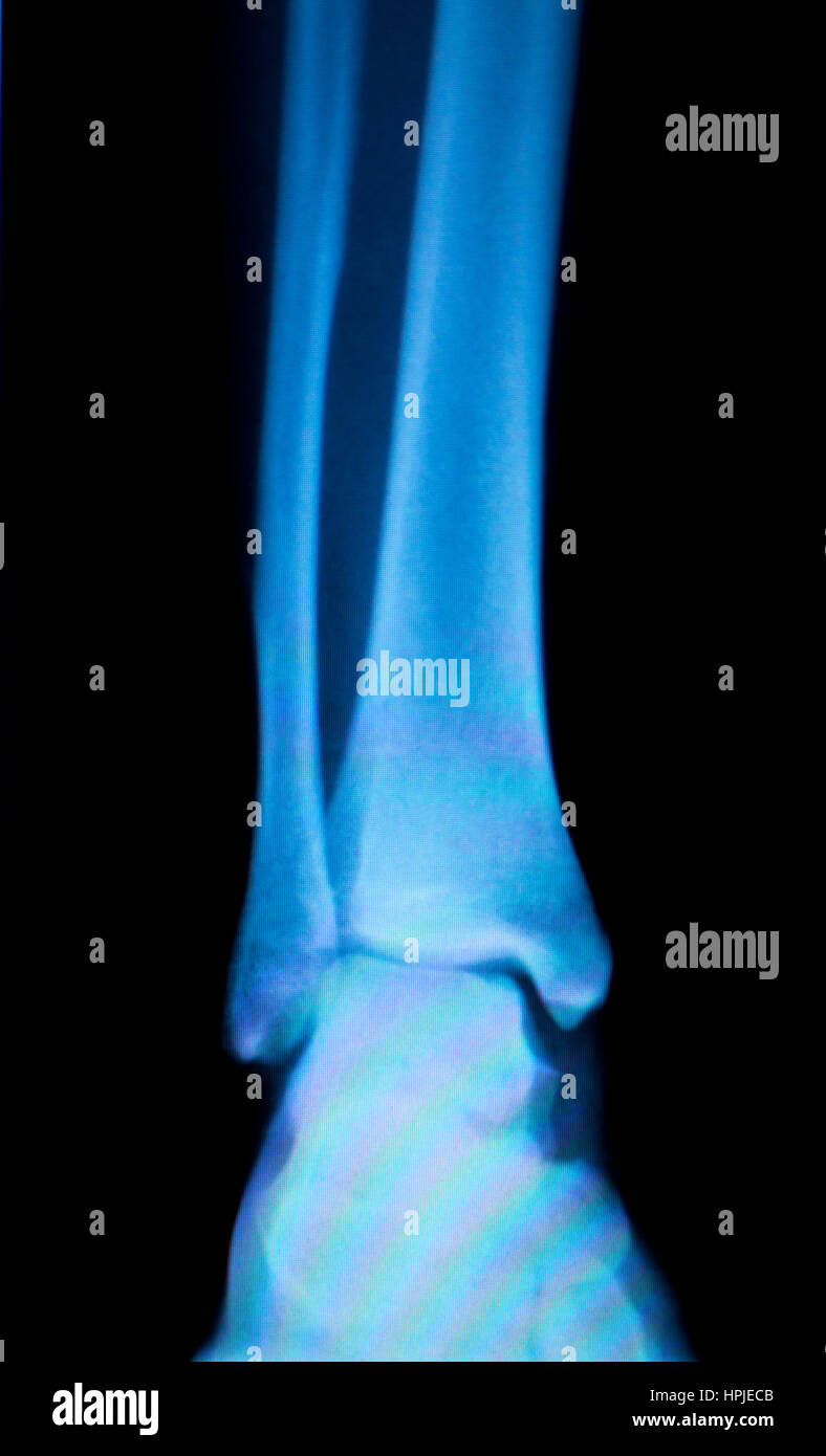 Xray foot heel ankle test scan results showing orthopedic titanium